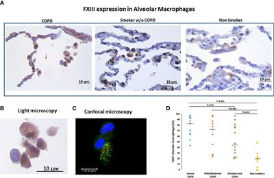 Macrophages-derived Factor XIII links coagulation to inflammation in COPD